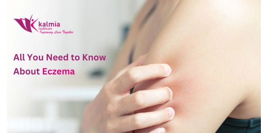 All You Need to Know About Eczema 4 All You Need to Know About Eczema